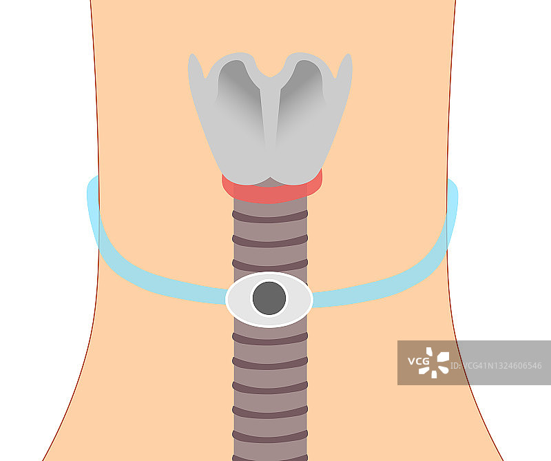 气管造口管带袖口。气管解剖前方可视化。图片素材