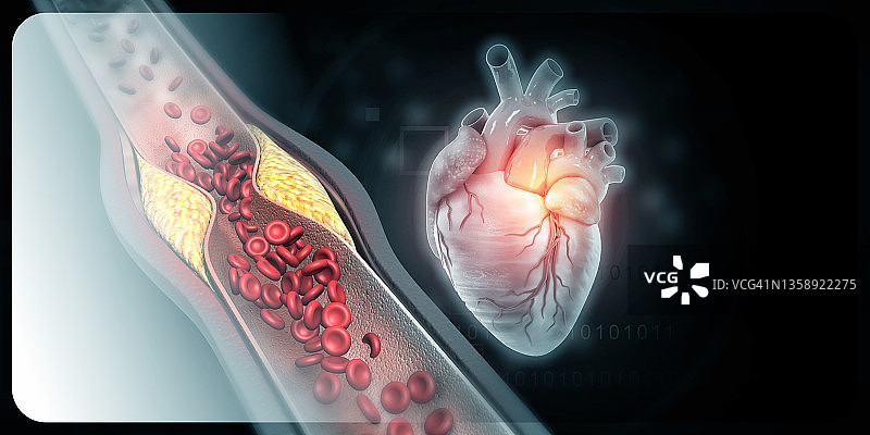 动脉内胆固醇斑块的人体心脏解剖图片素材