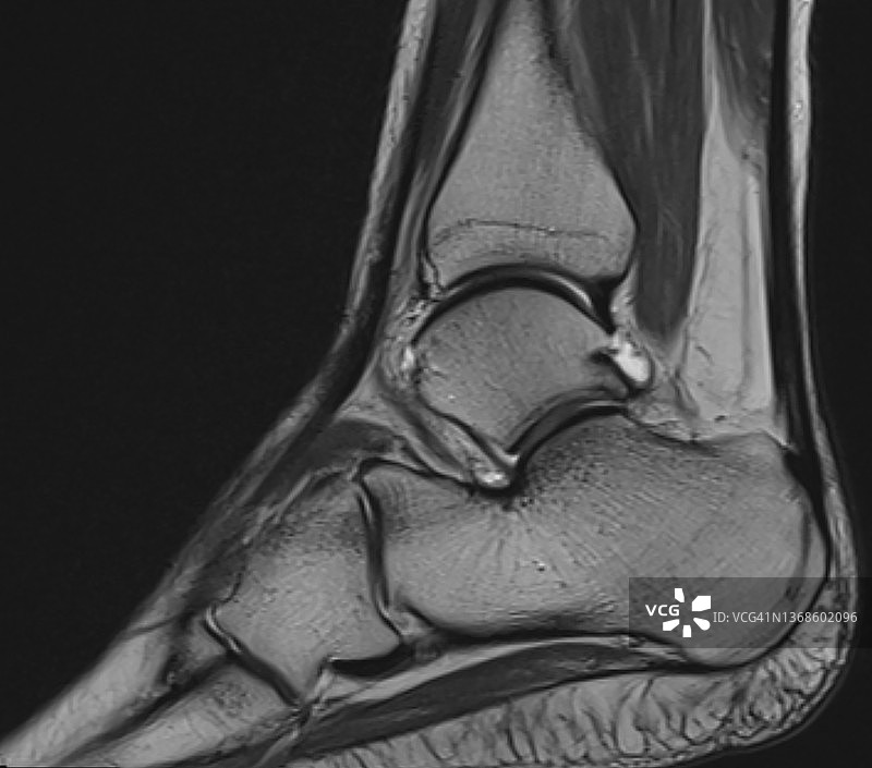 足部和踝关节的磁共振成像图片素材