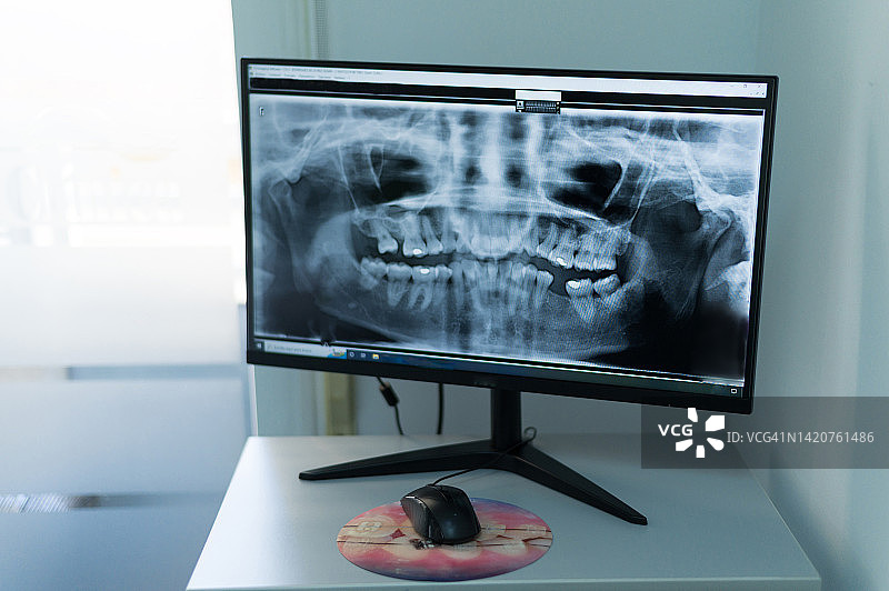 牙科x光监视器上的牙齿x光图像，牙科诊所电脑显示器上的牙齿x光图像，办公室显示器上显示的牙齿x光图像的概念图片素材