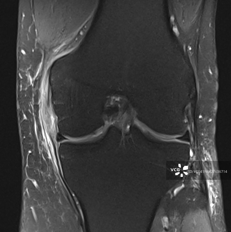 膝关节内侧副韧带损伤MCL，冠状位PD Fat Sat图像MRI图片素材