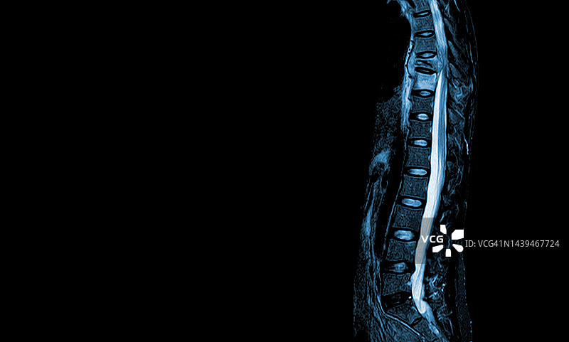 胸椎MRI: T9椎体中度病理性压缩骨折伴T9-10椎旁脓肿。图片素材