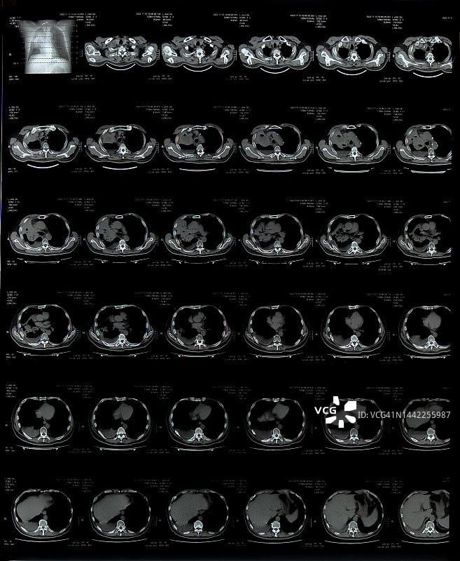 肺部肿瘤CT扫描图片素材