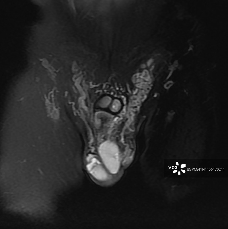 男性不孕症精索静脉曲张的磁共振诊断图片素材