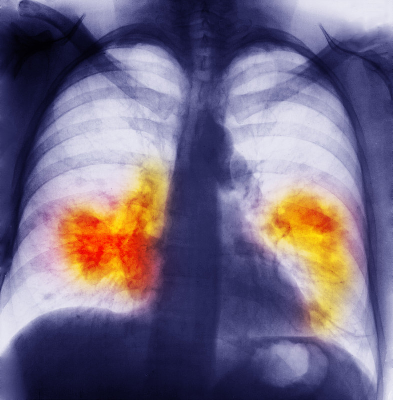 胸部x光片显示肺癌图片下载