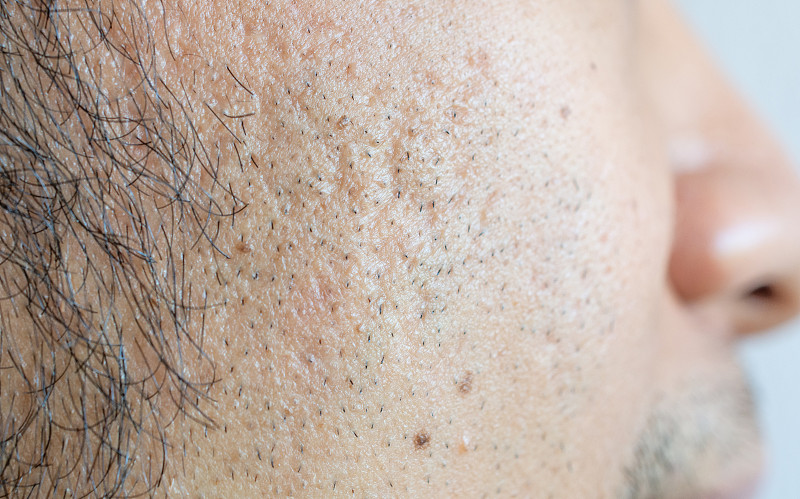 男人的脸部有各种各样的皮肤问题(如痤疮、皱纹、毛孔和鱼尾纹等)。图片下载