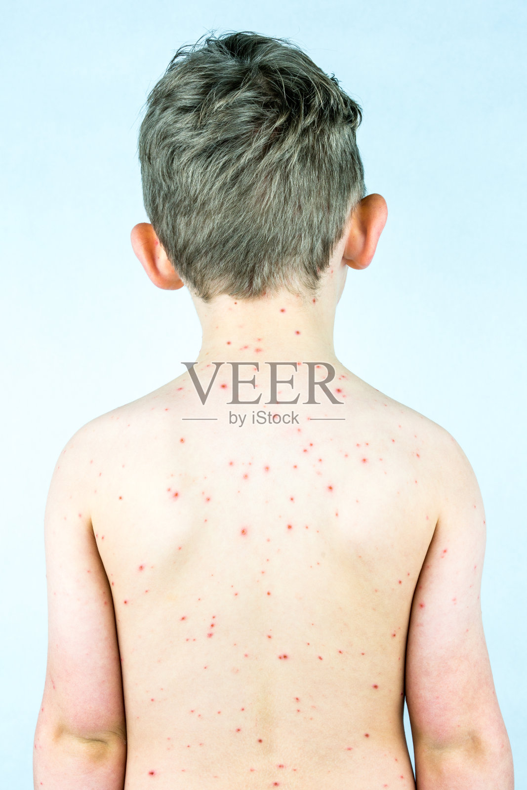 有水痘的男孩，背部有疹子和水疱。照片摄影图片