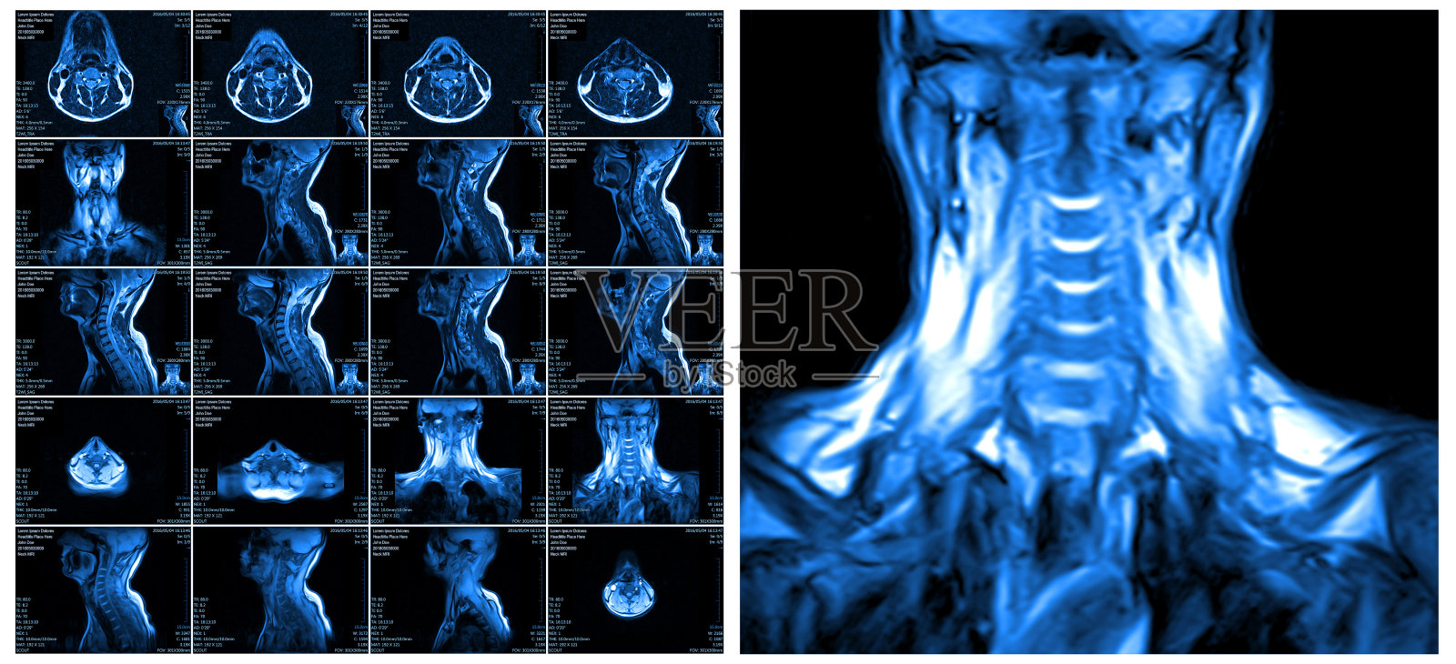 颈椎的磁共振成像。照片摄影图片