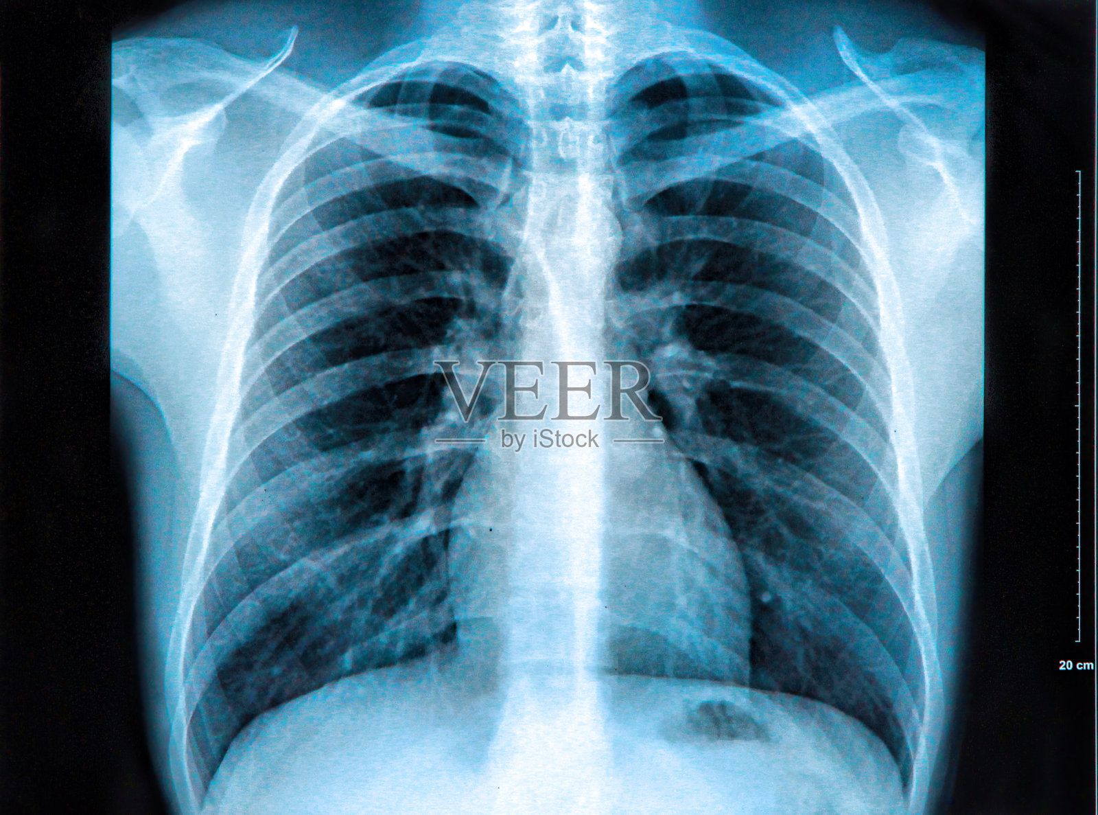 胸部x光片，显示肺、心脏和肋骨照片摄影图片