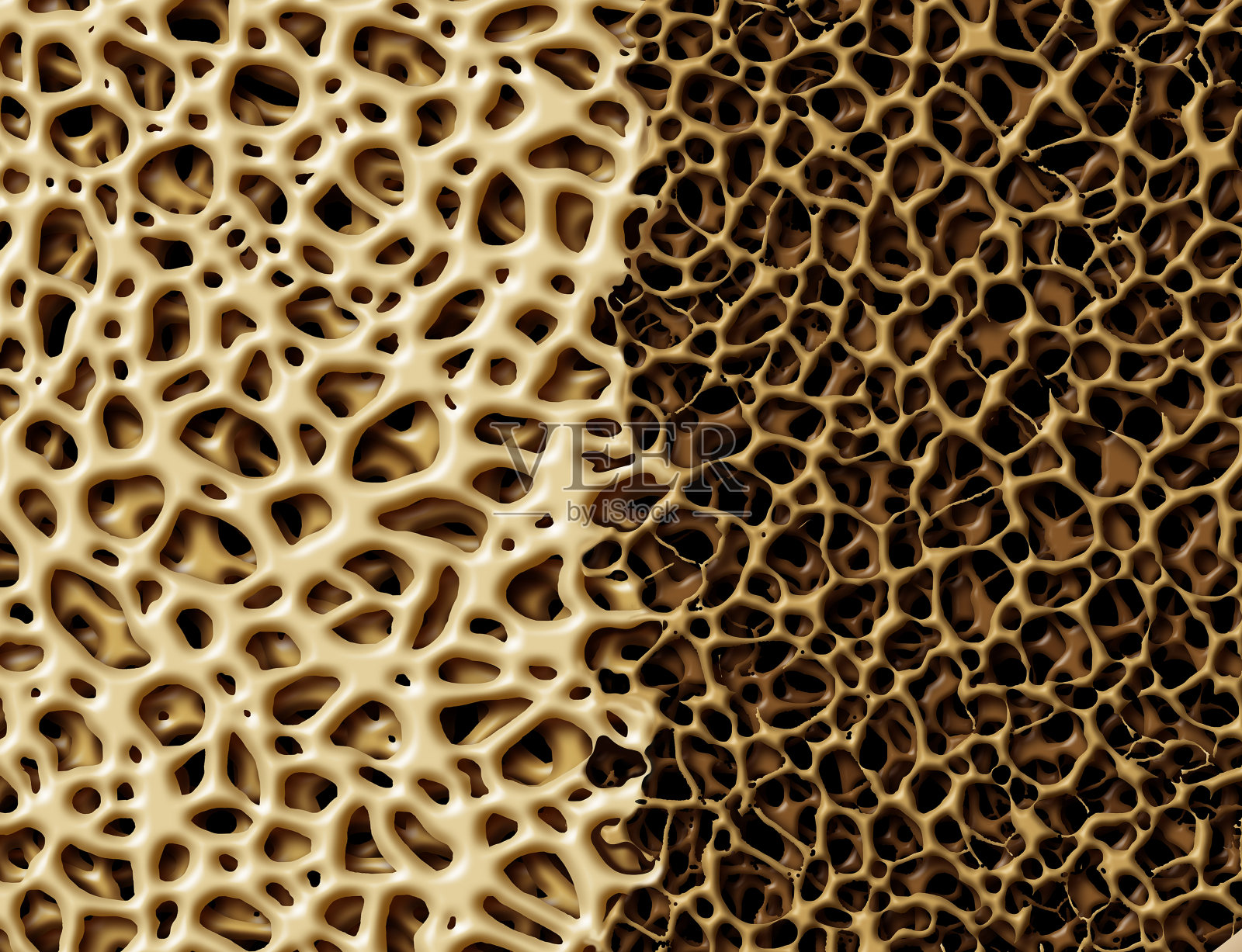 骨与Osteoperosis照片摄影图片