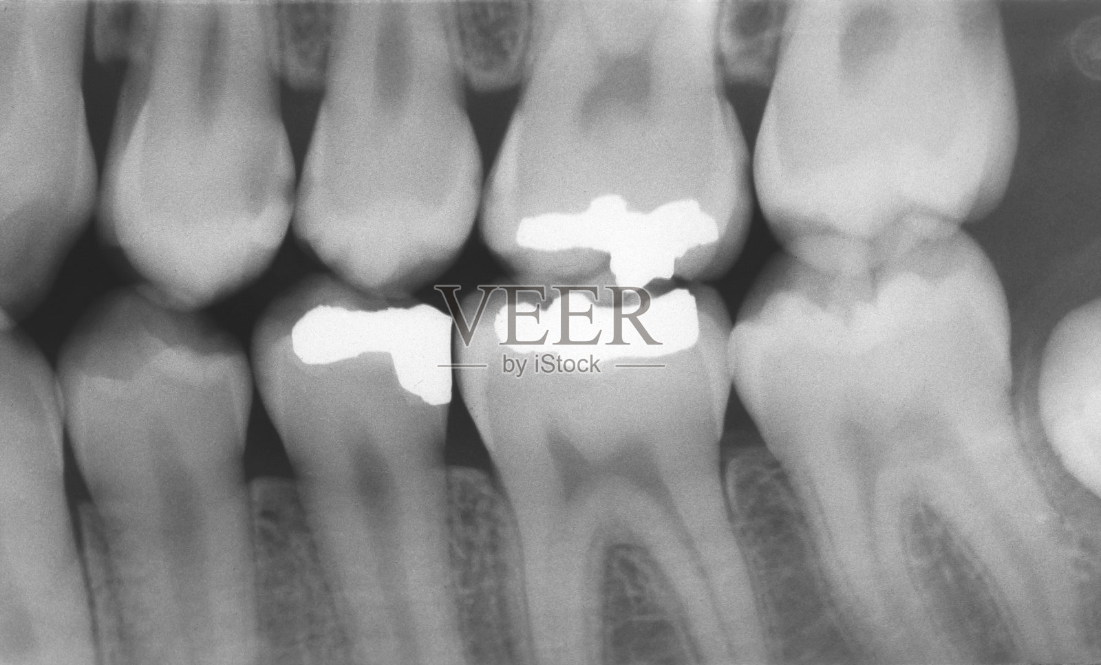 含金属补牙的牙科x光片照片摄影图片