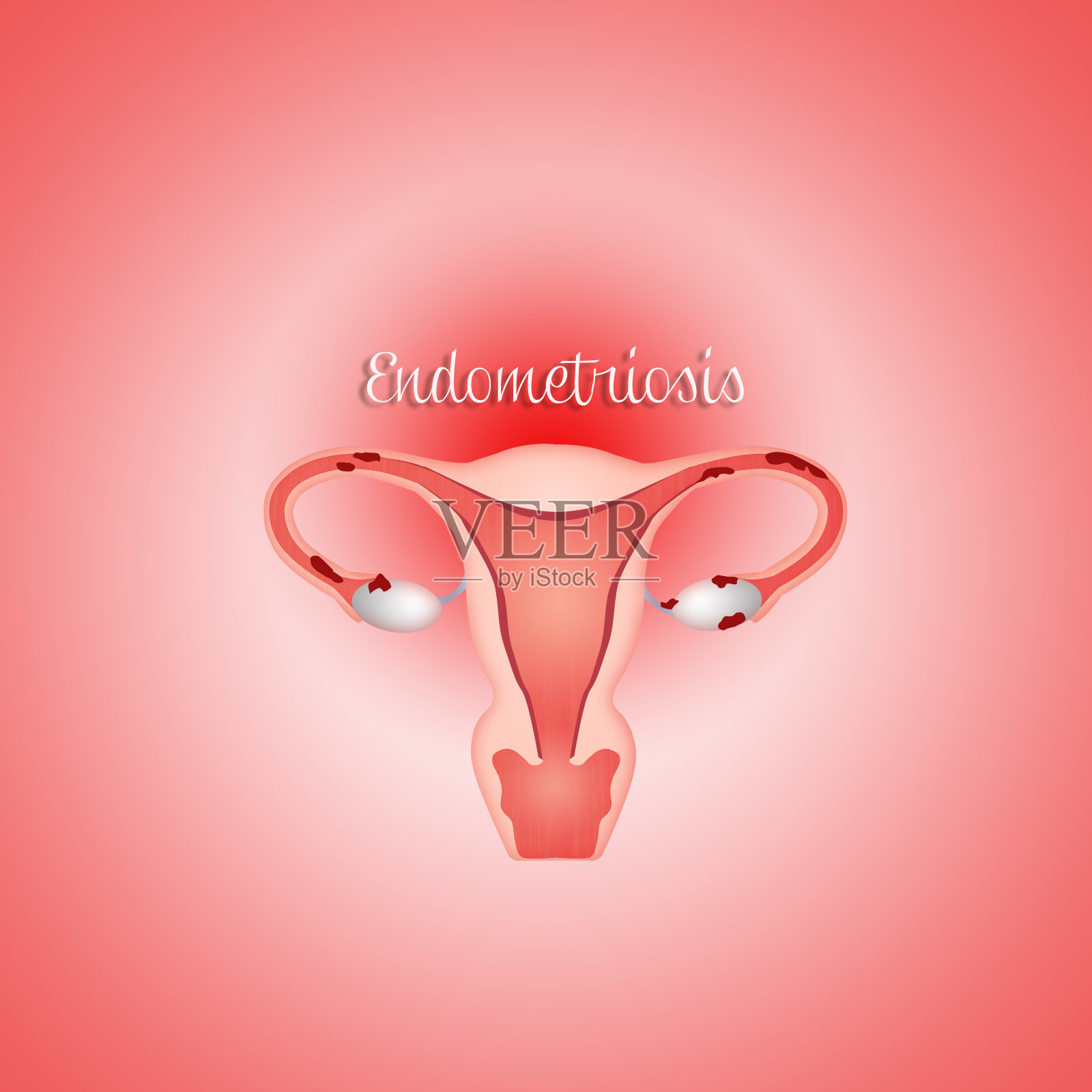 子宫和子宫内膜异位插画图片素材