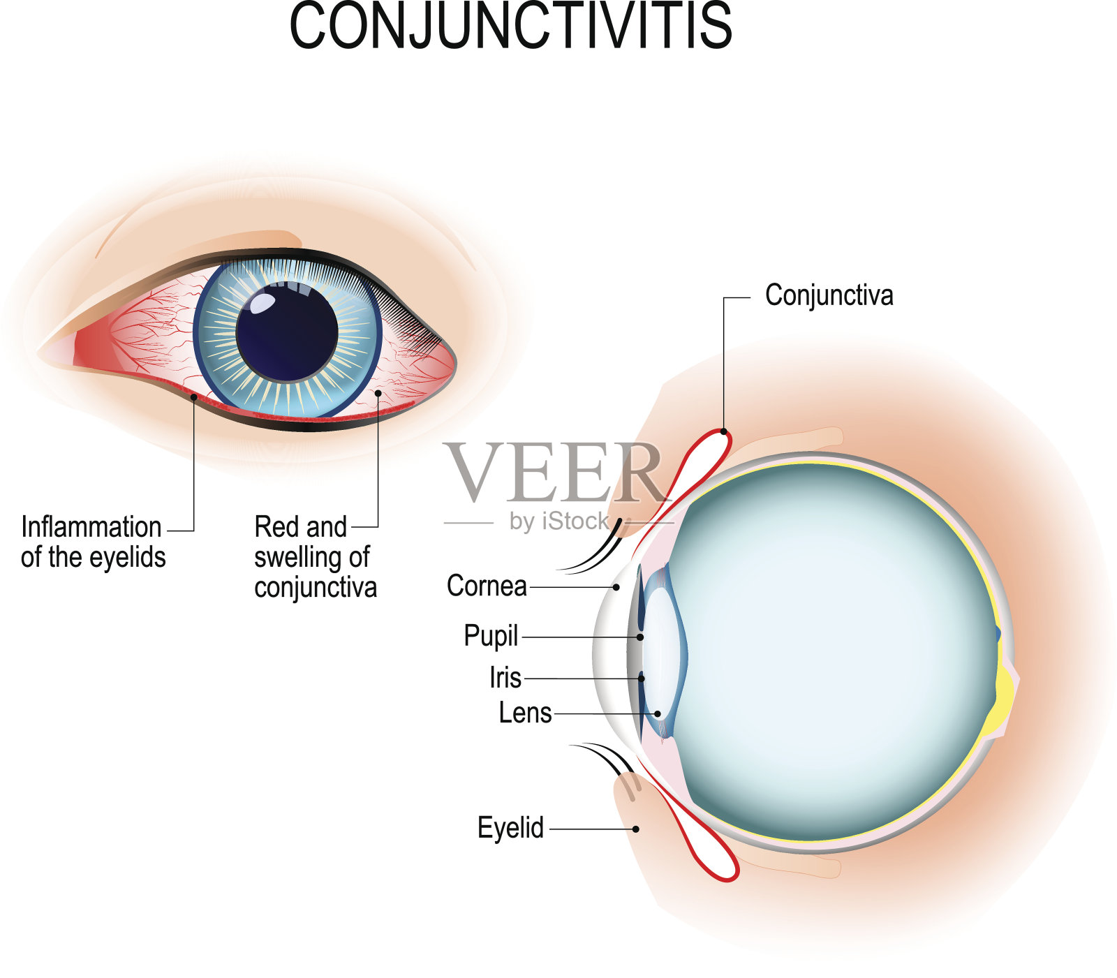 结膜炎外部视图和人眼的垂直切片插画图片素材