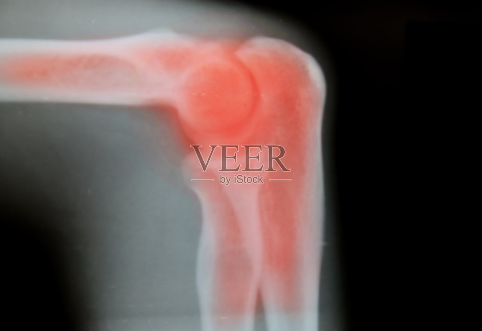 大腿骨x线医学背景照片摄影图片