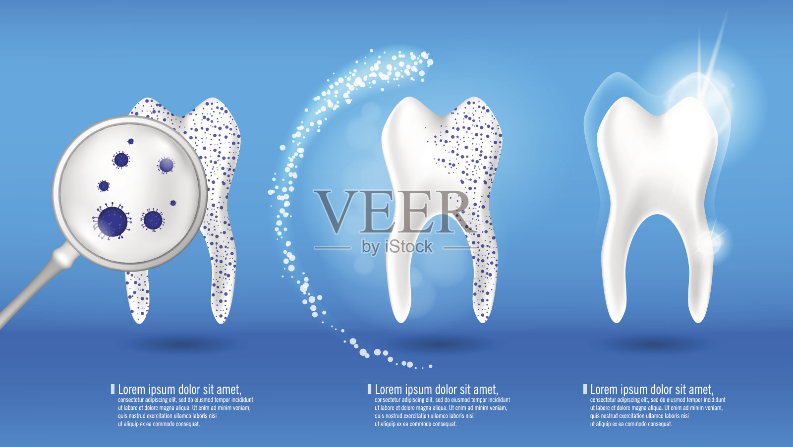 牙齿健康概念向量集。3d现实闪亮的干净和脏的牙齿在蓝色的背景，清除和美白牙齿的过程。口腔护理，牙齿修复插画图片素材