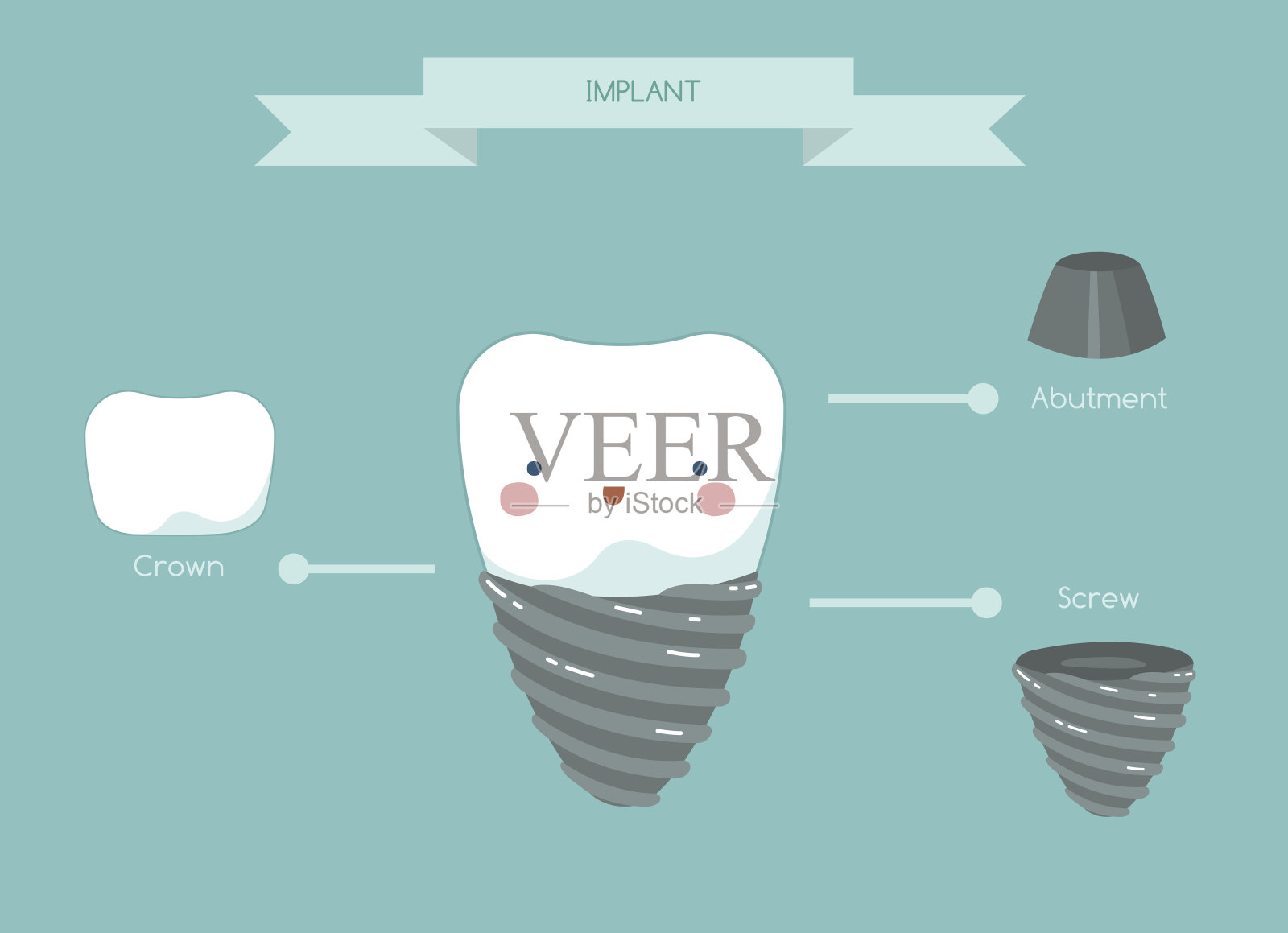 牙种植体的结构、牙体和牙体的概念插画图片素材