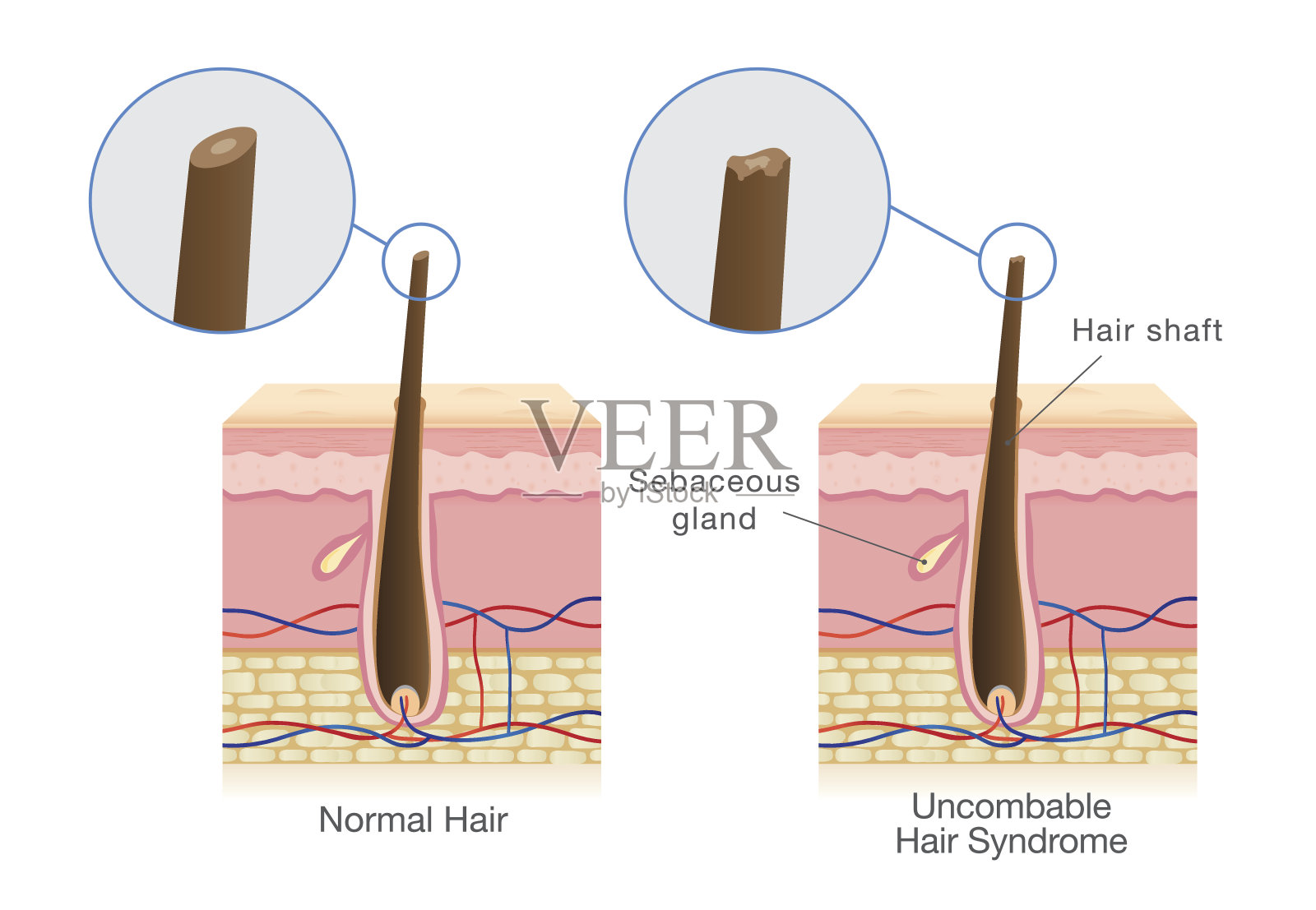 正常发干与不可梳发综合征的区别。插画图片素材