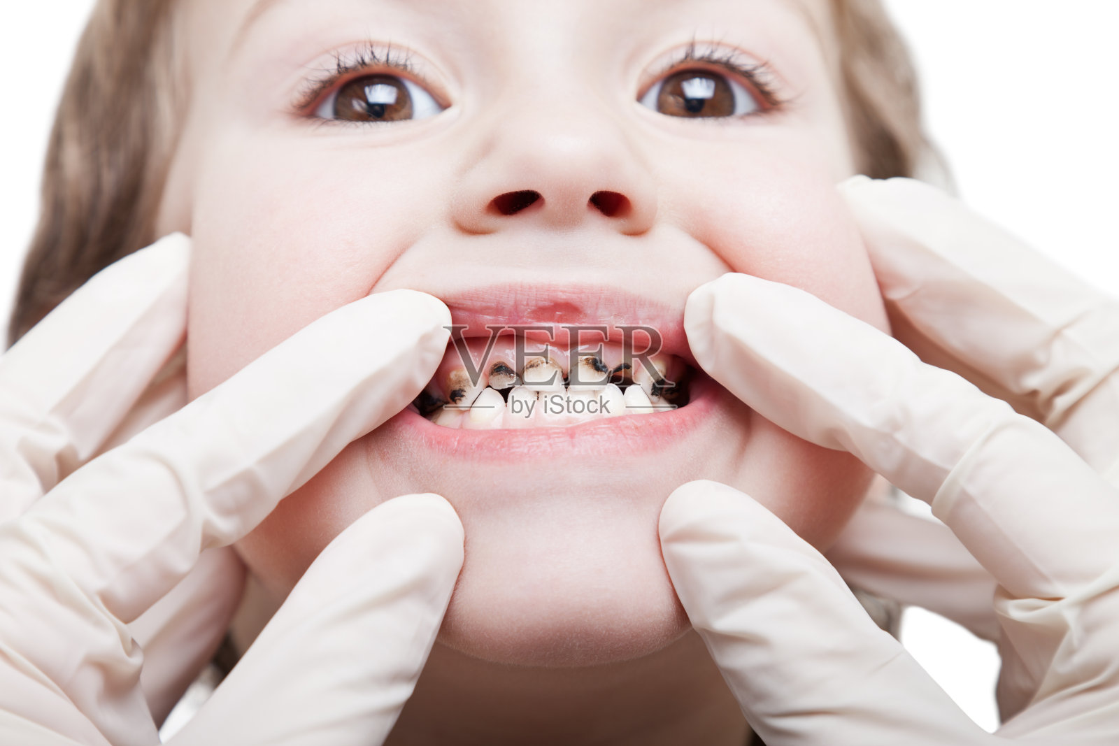 十个孩子八个蛀牙，儿童龋齿要不要治疗？ - 知乎