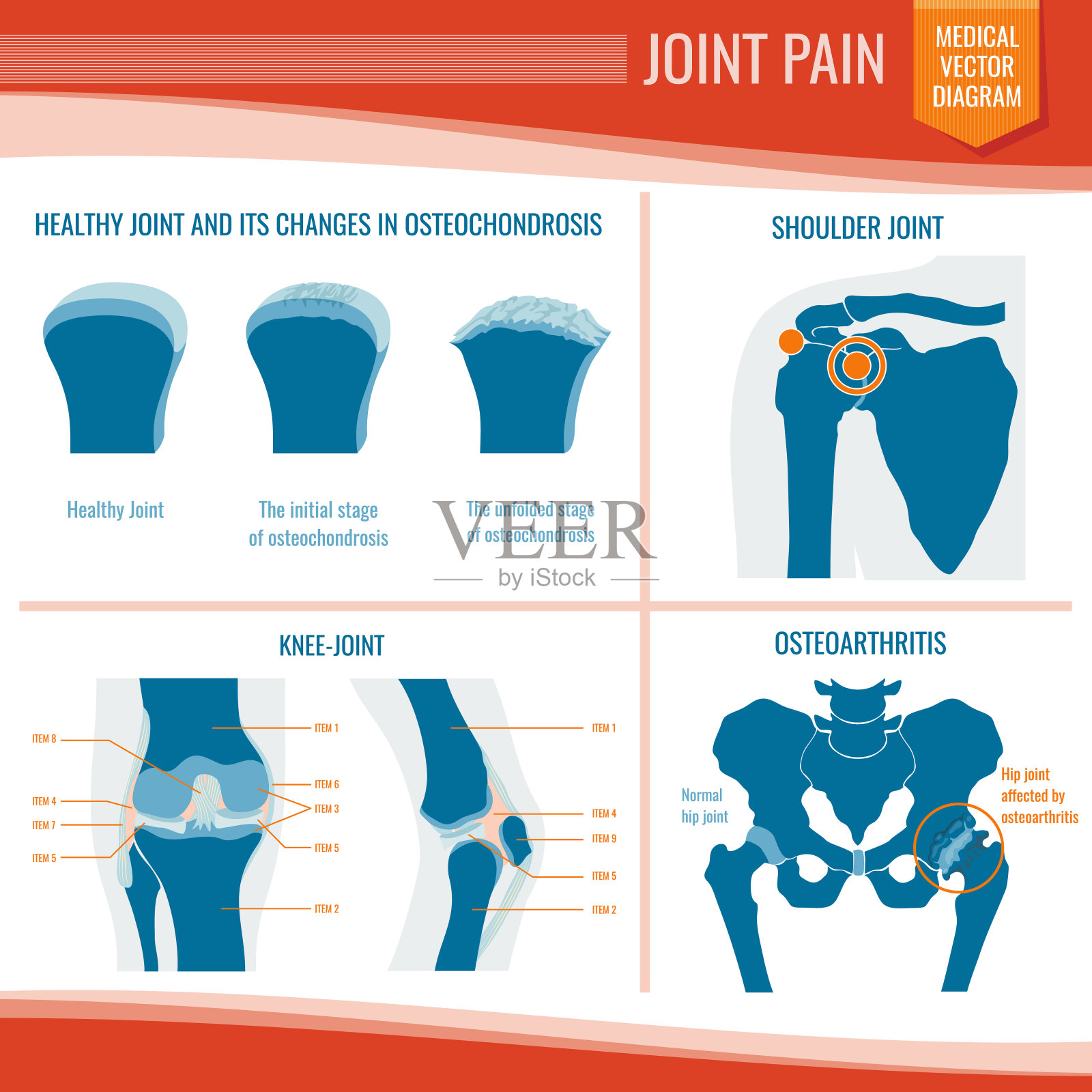 骨关节炎和风湿关节疼痛医学矢量信息图插画图片素材