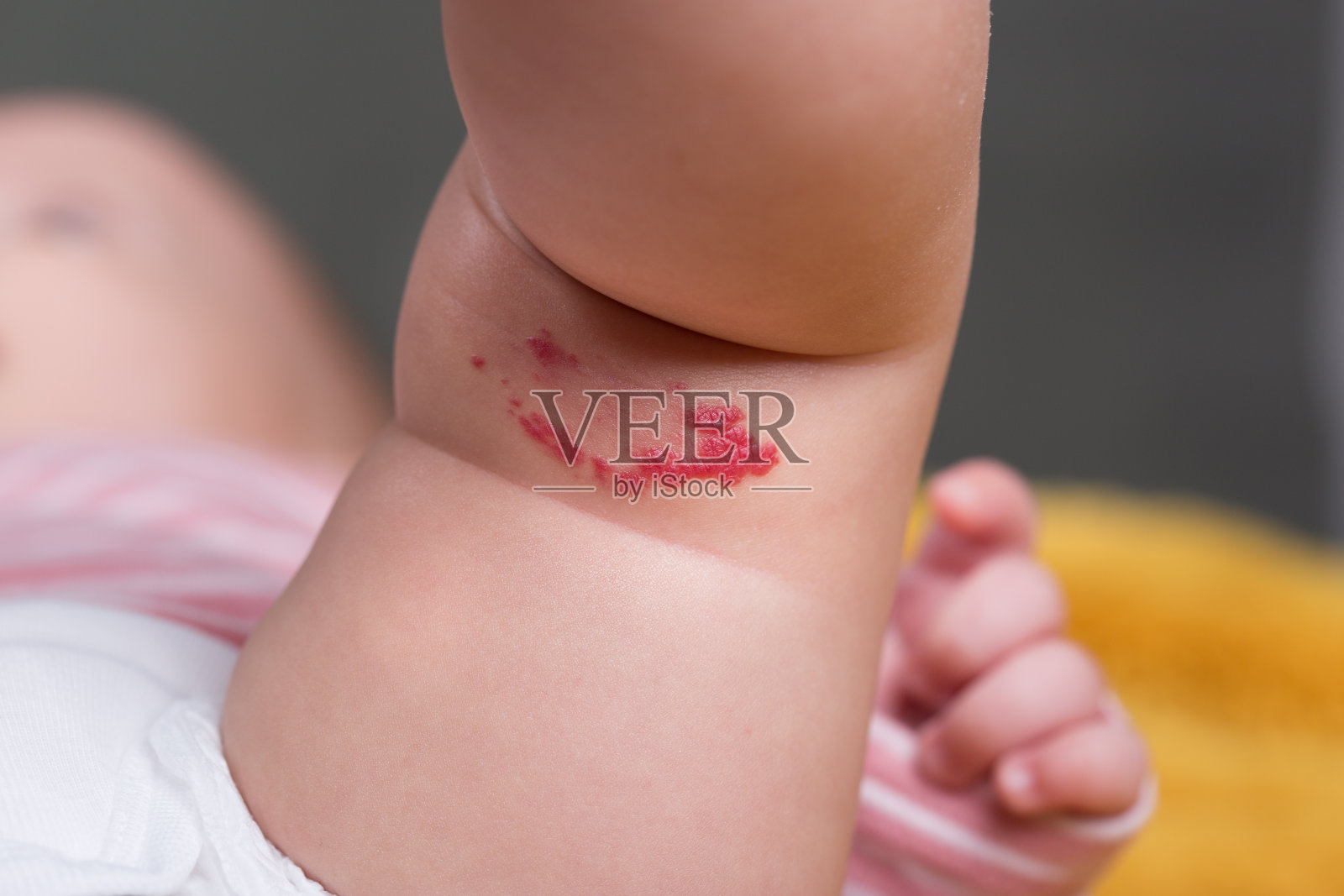 婴儿腿上的毛细血管瘤红色胎记照片摄影图片