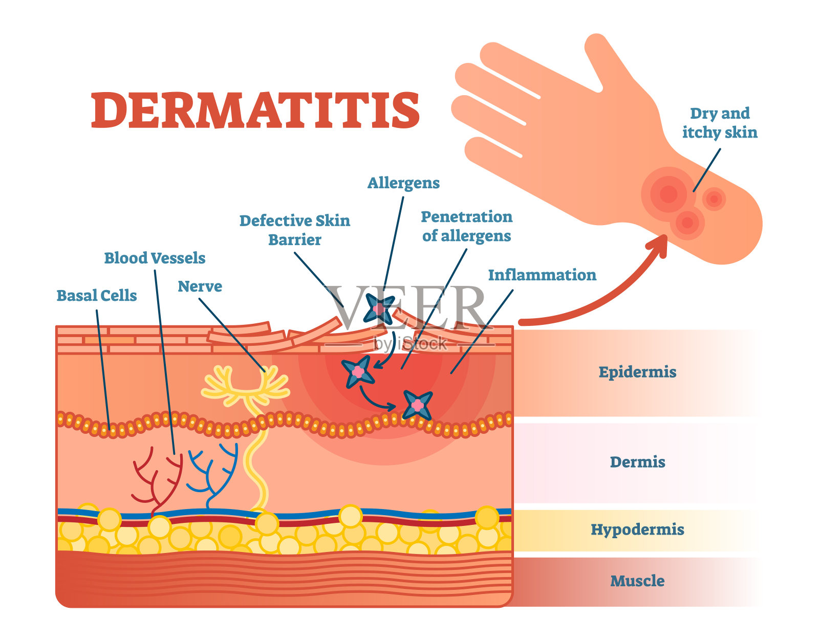 皮炎平面矢量图解与皮肤层和过敏原运动。插画图片素材