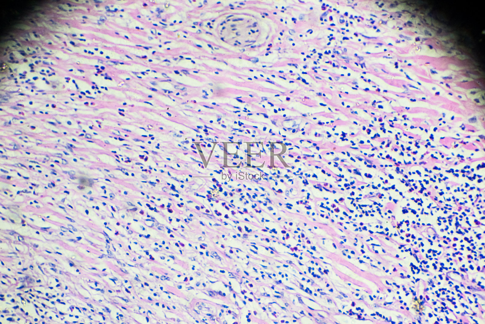 何杰金氏细胞病，淋巴瘤，显微镜下的HL照片摄影图片