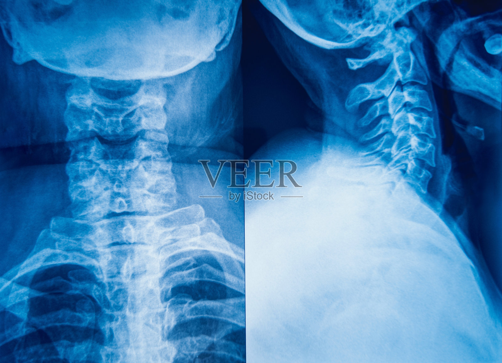 用于医学诊断的人体颈部x光图像。照片摄影图片