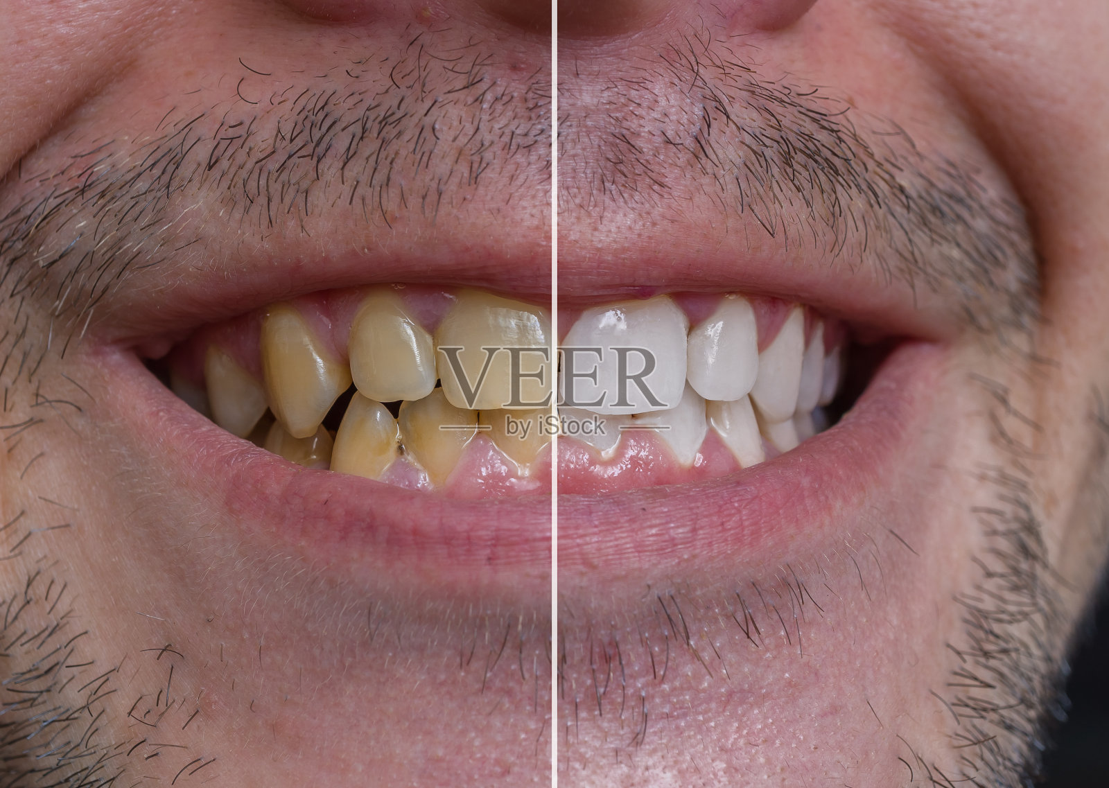 牙齿美白的概念。微笑的男人，黄牙，前后。照片摄影图片