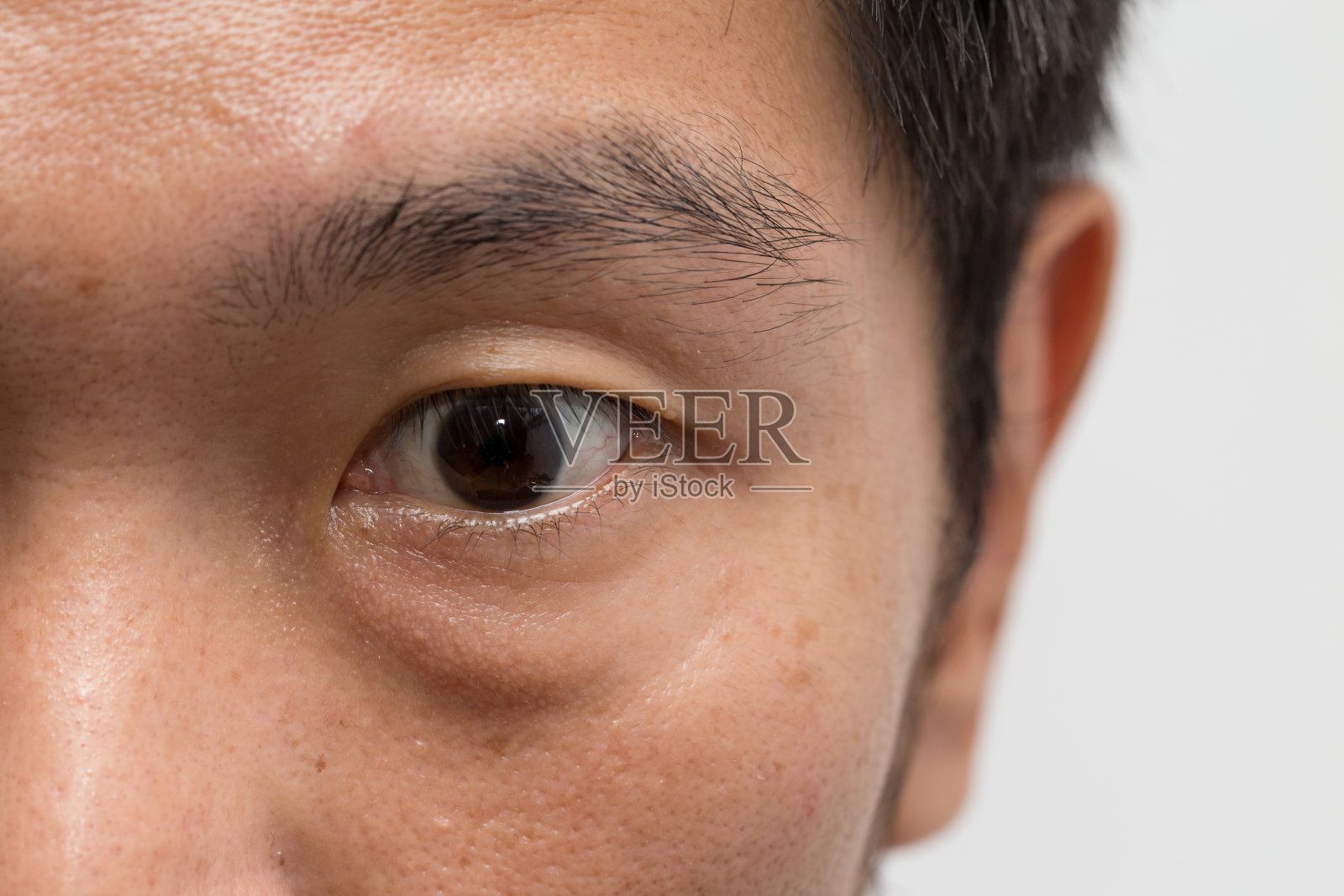 亚洲男性面部皮肤油腻，左眼有大眼袋照片摄影图片