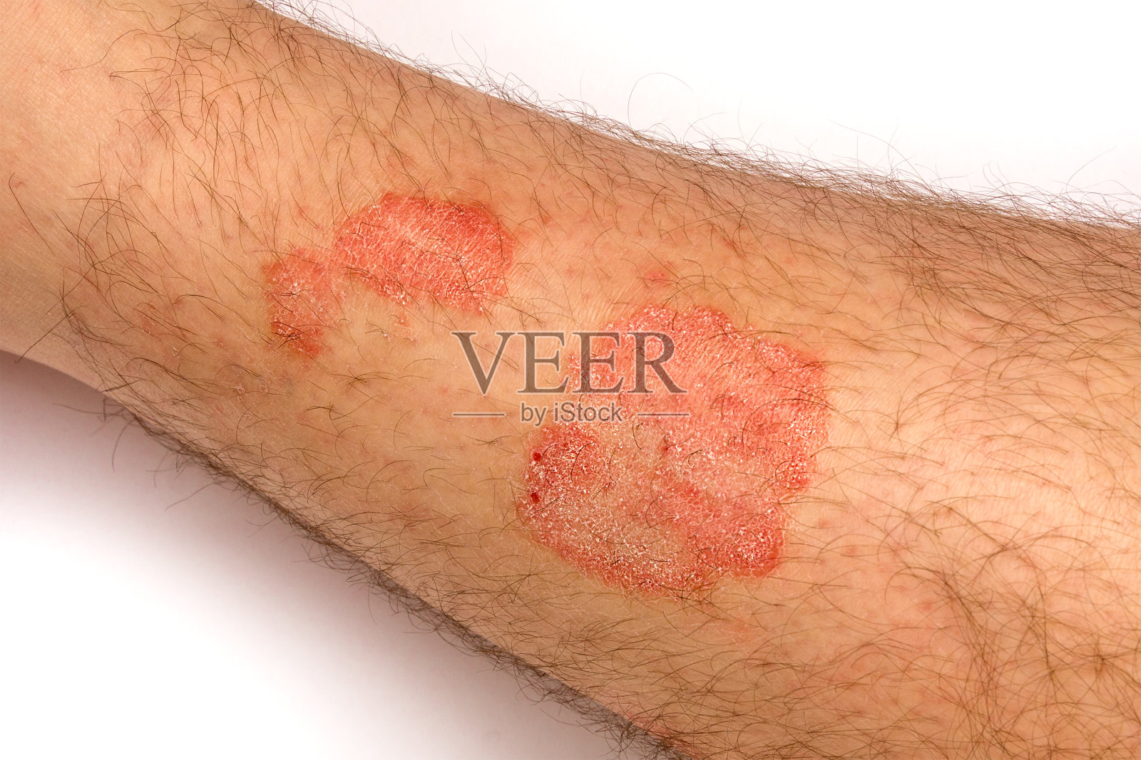 牛皮癣的皮肤。病人皮肤上的皮疹和鳞屑的特写。慢性病治疗的概念照片摄影图片