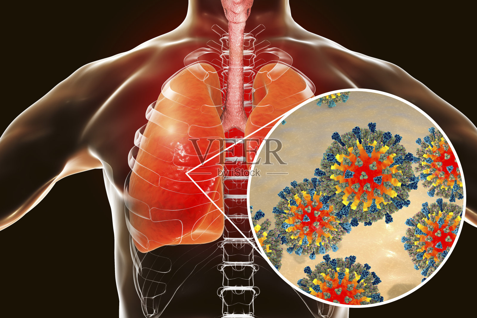 人类呼吸系统中的麻疹病毒照片摄影图片