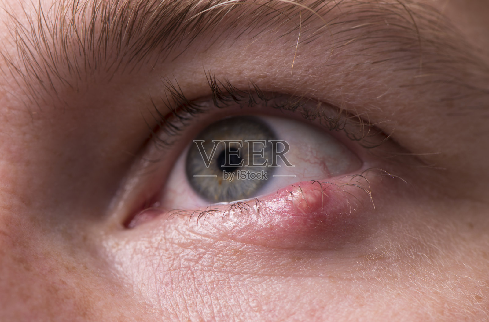 靠近感染的眼睛，下眼睑有疼痛的肿块。照片摄影图片