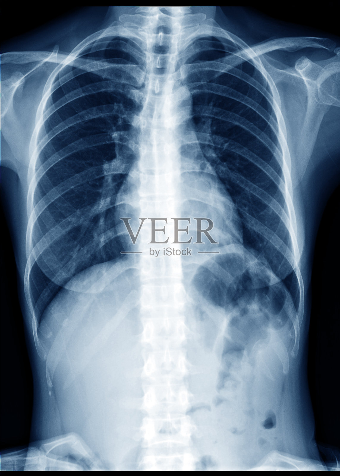 正常健康女性的胸部x光片显示肺，心脏，脊柱，锁骨，隔膜照片摄影图片