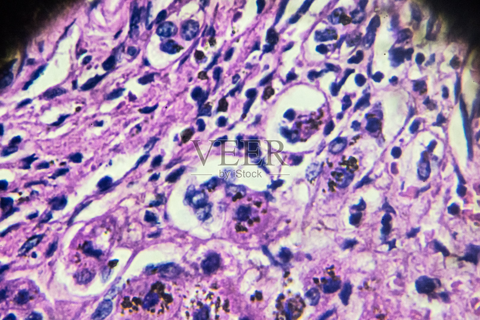 胆汁性肝硬化。显微镜下的人类病理标本照片摄影图片
