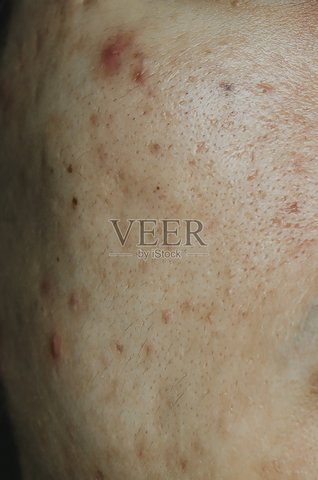 由激素引起的皮肤上的痤疮和丘疹造成的疤痕和皱纹。照片摄影图片