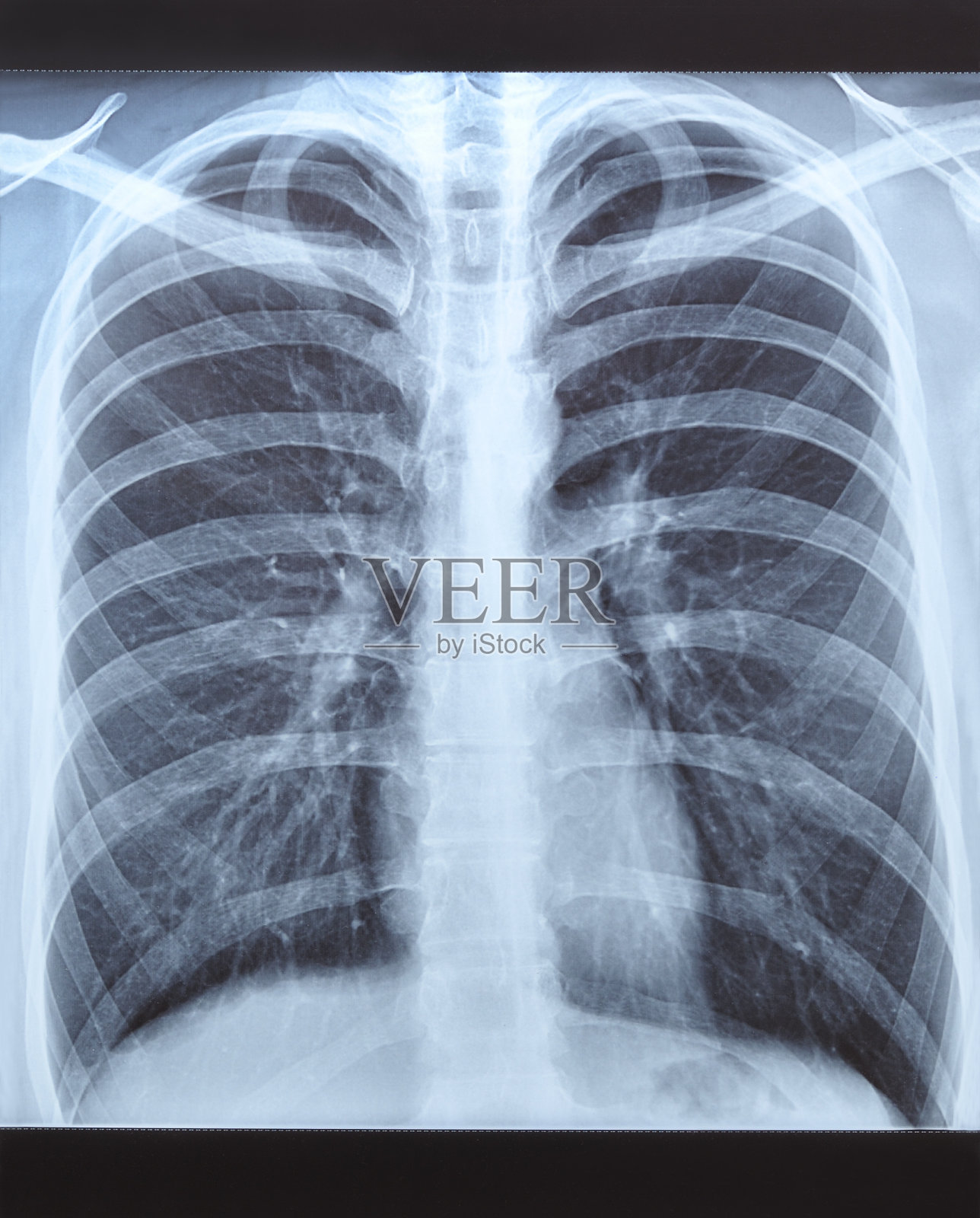 一个人的肺部x光照片。照片摄影图片