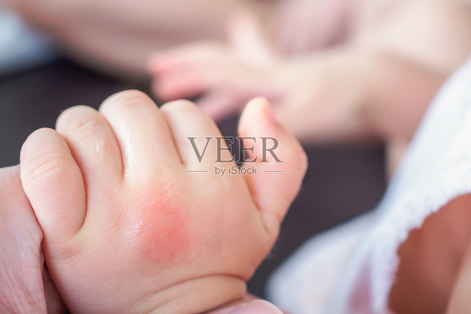 婴儿的手有皮疹和过敏，由蚊子叮咬引起的红斑照片摄影图片