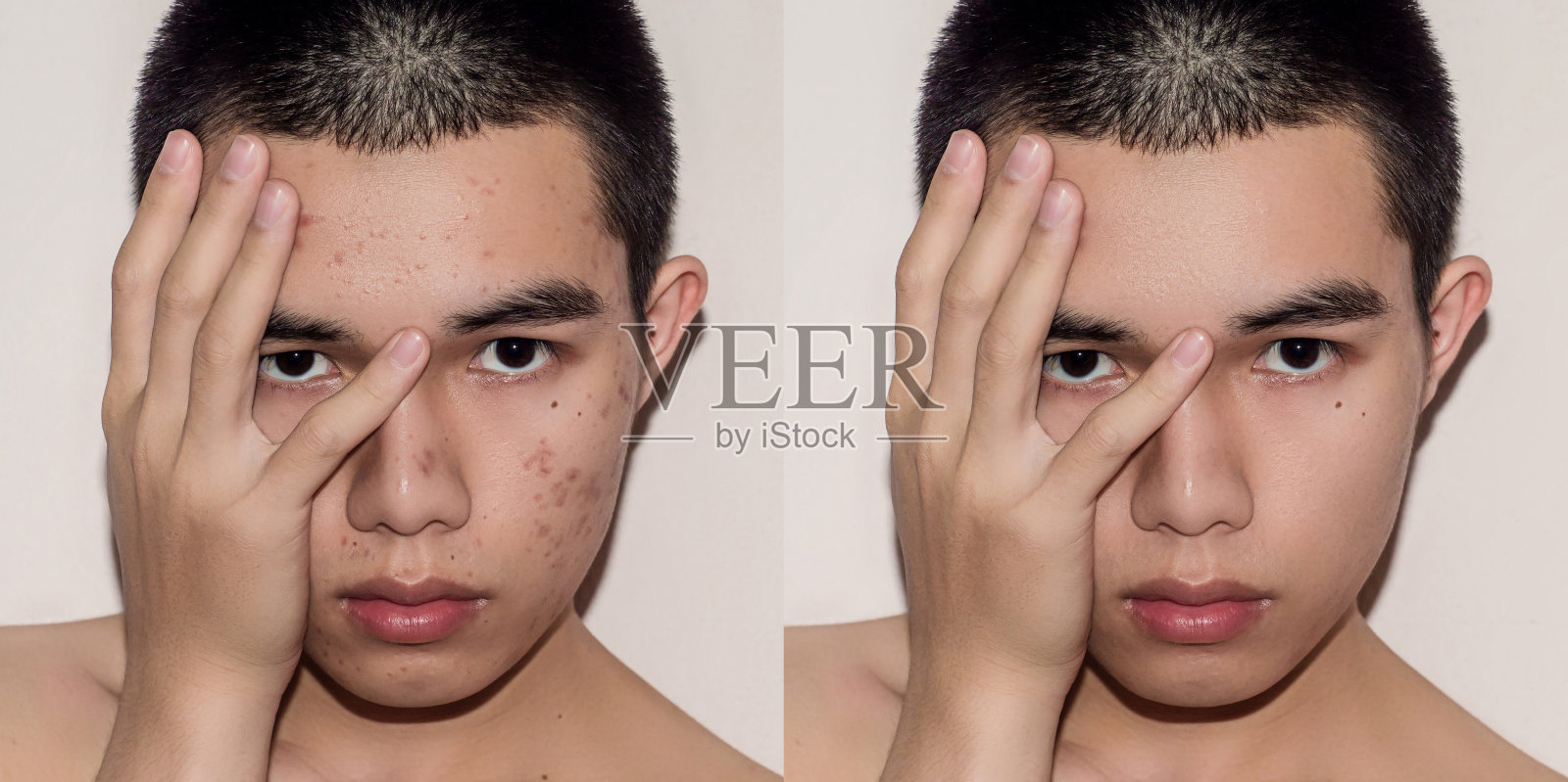 青年男子治疗前后由痤疮和丘疹去除痤疮。照片摄影图片