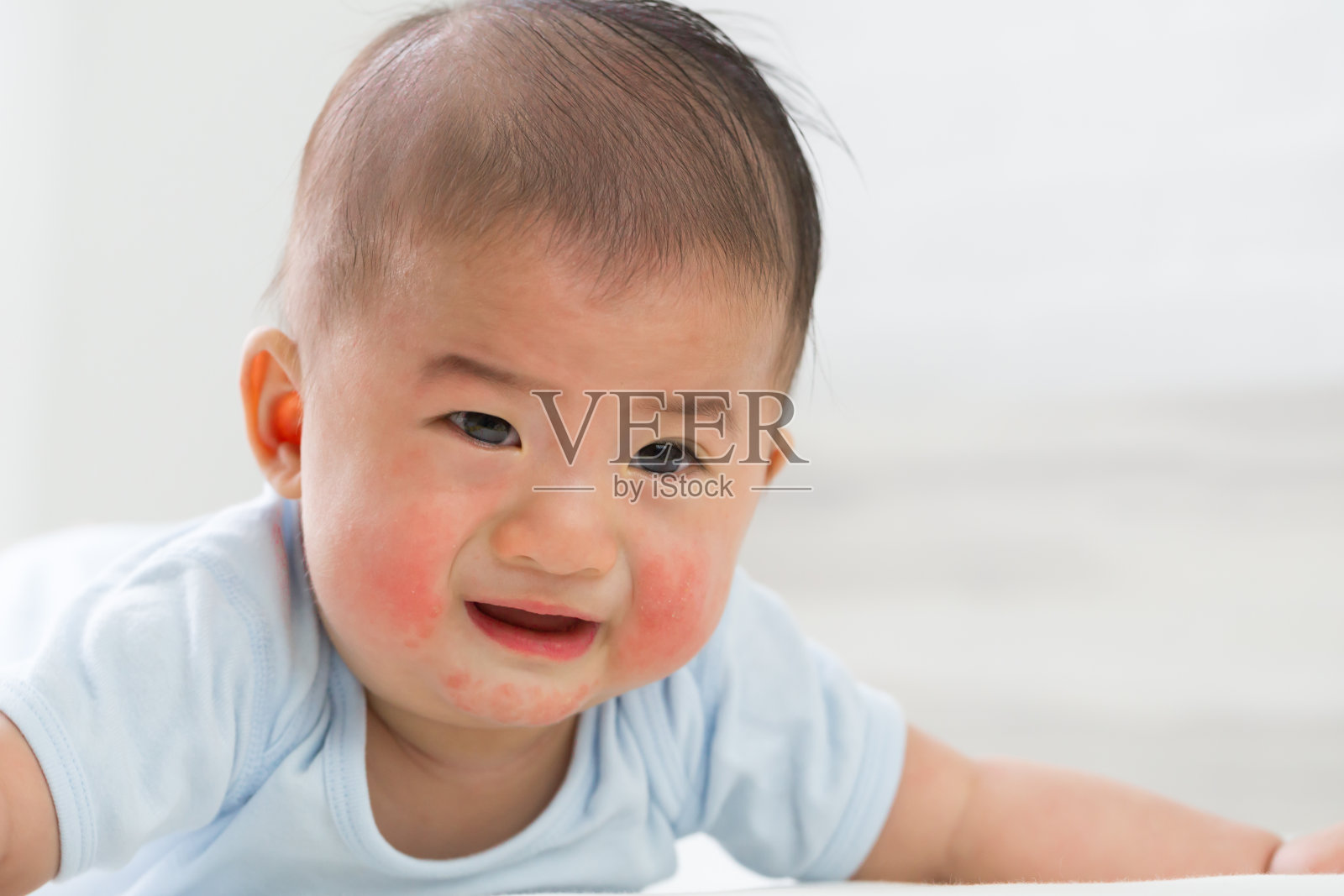 婴儿的皮疹概念照片摄影图片