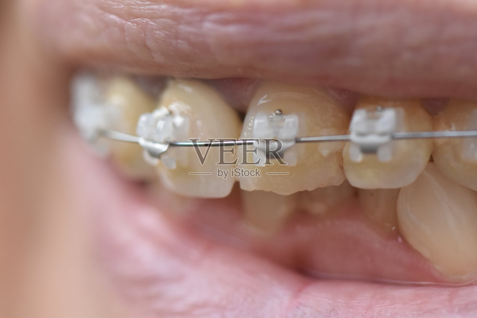 女人的微笑和牙齿上的牙齿矫正器照片摄影图片