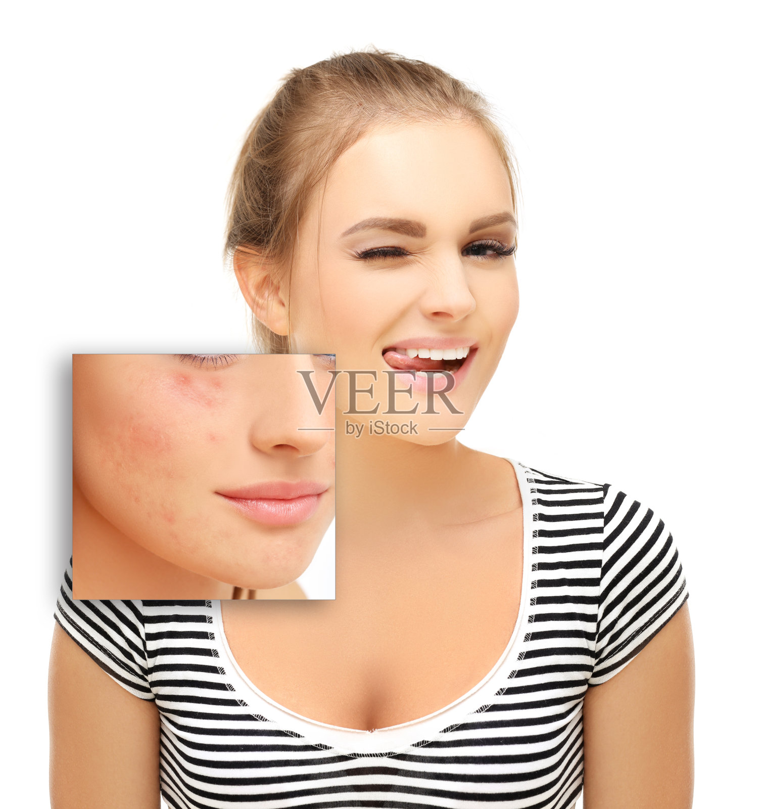 Post-Acne标志,痤疮疤痕照片摄影图片