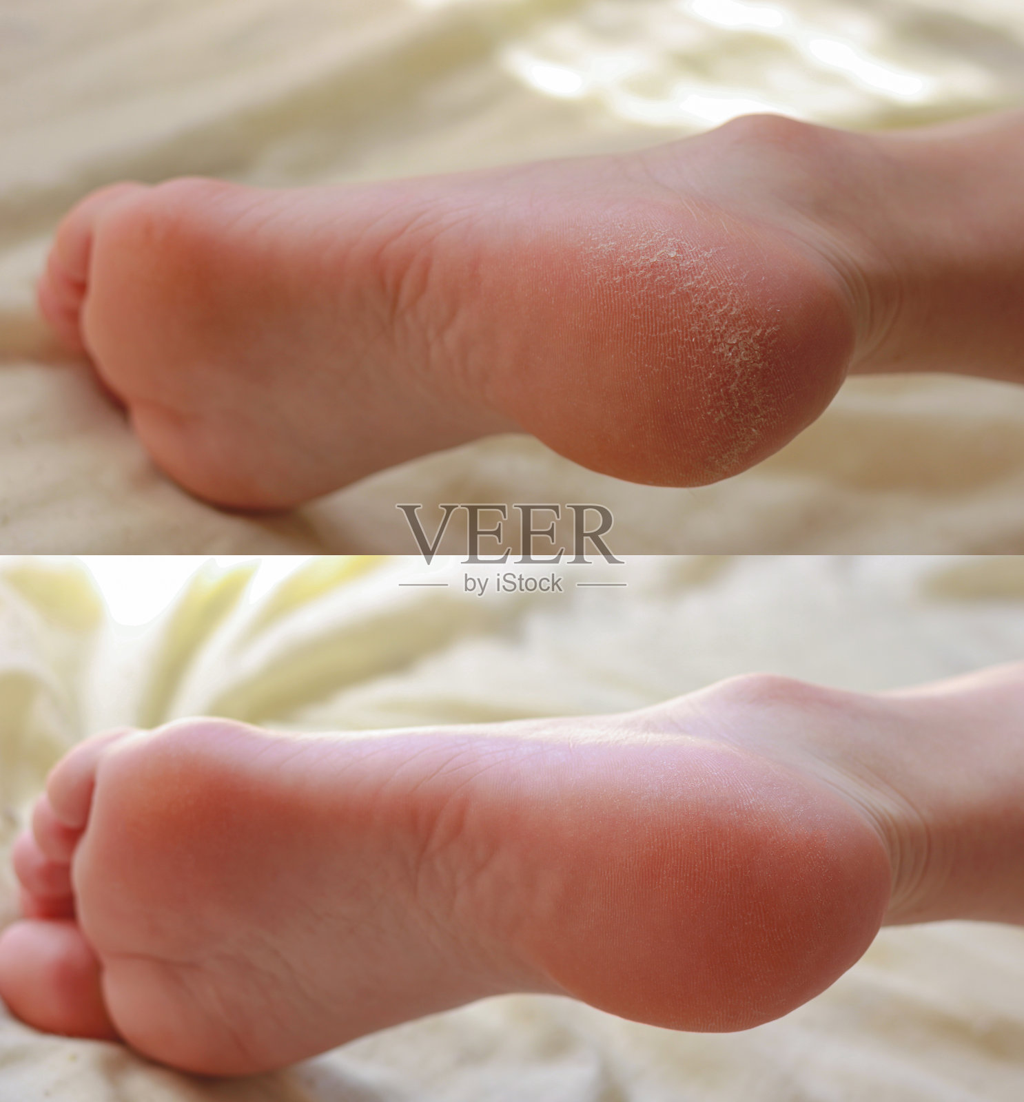 修脚。脚后跟有裂缝和干痂。邋遢整洁的腿。缺乏维生素。皮肤病的脚。治疗前后。照片摄影图片