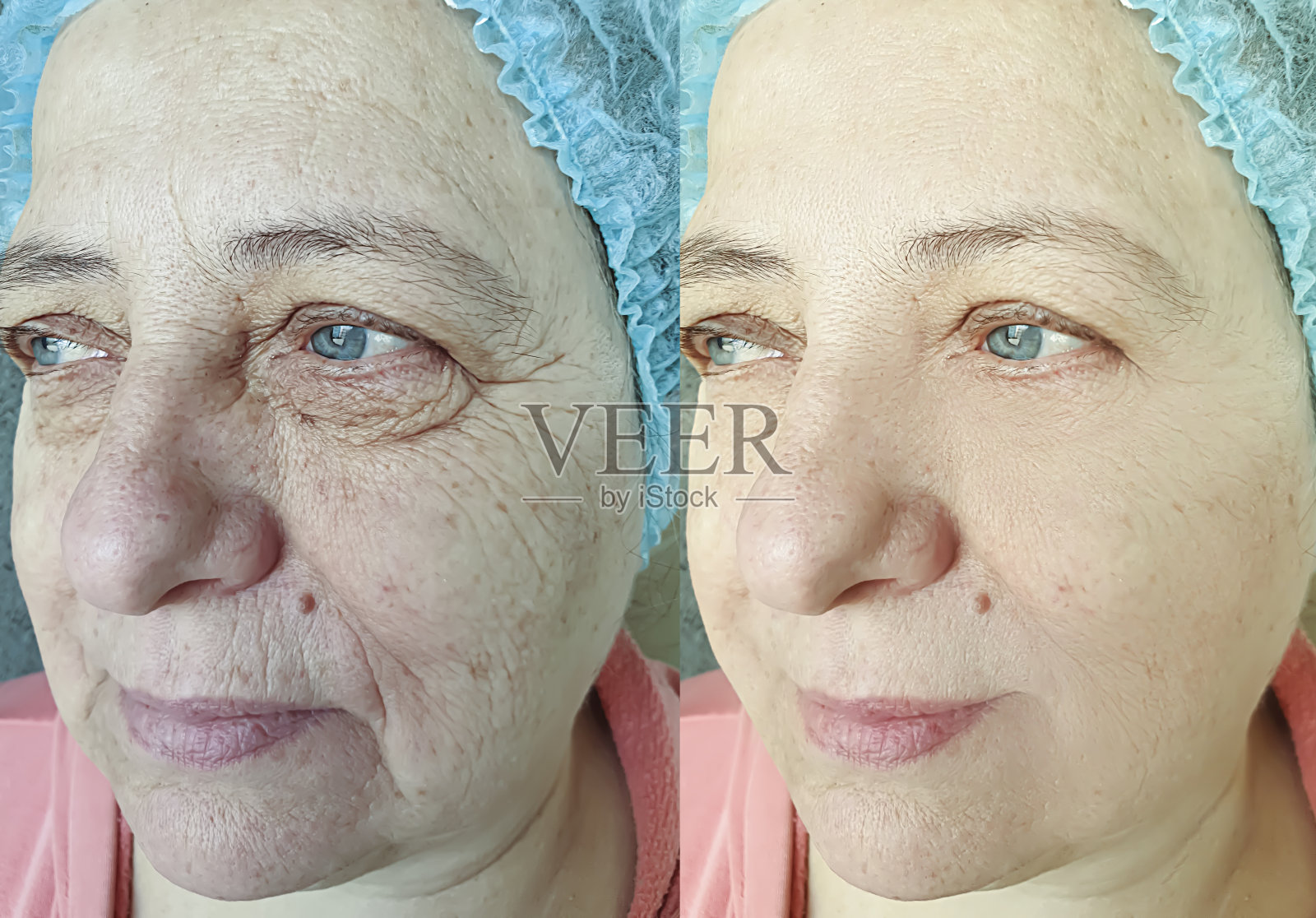 老年妇女面部皱纹治疗前后照片摄影图片