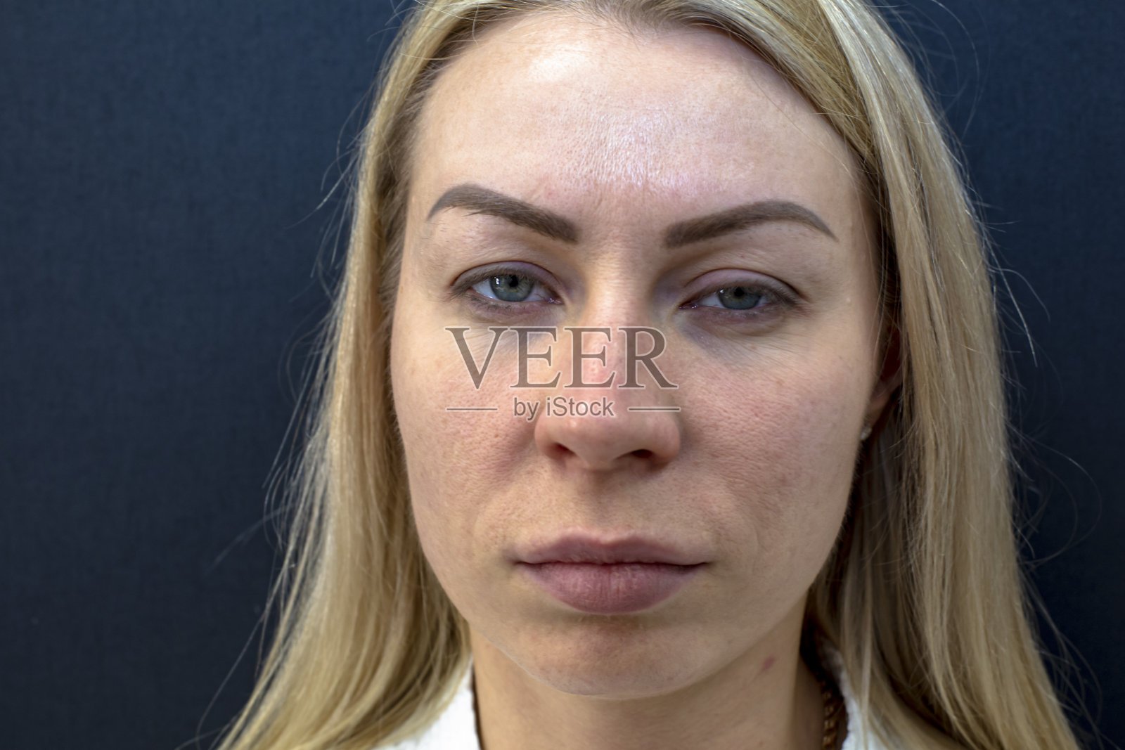 一个年轻女性的肖像与一个典型的问题痤疮，酒渣鼻和痤疮在成年。特写镜头。照片摄影图片