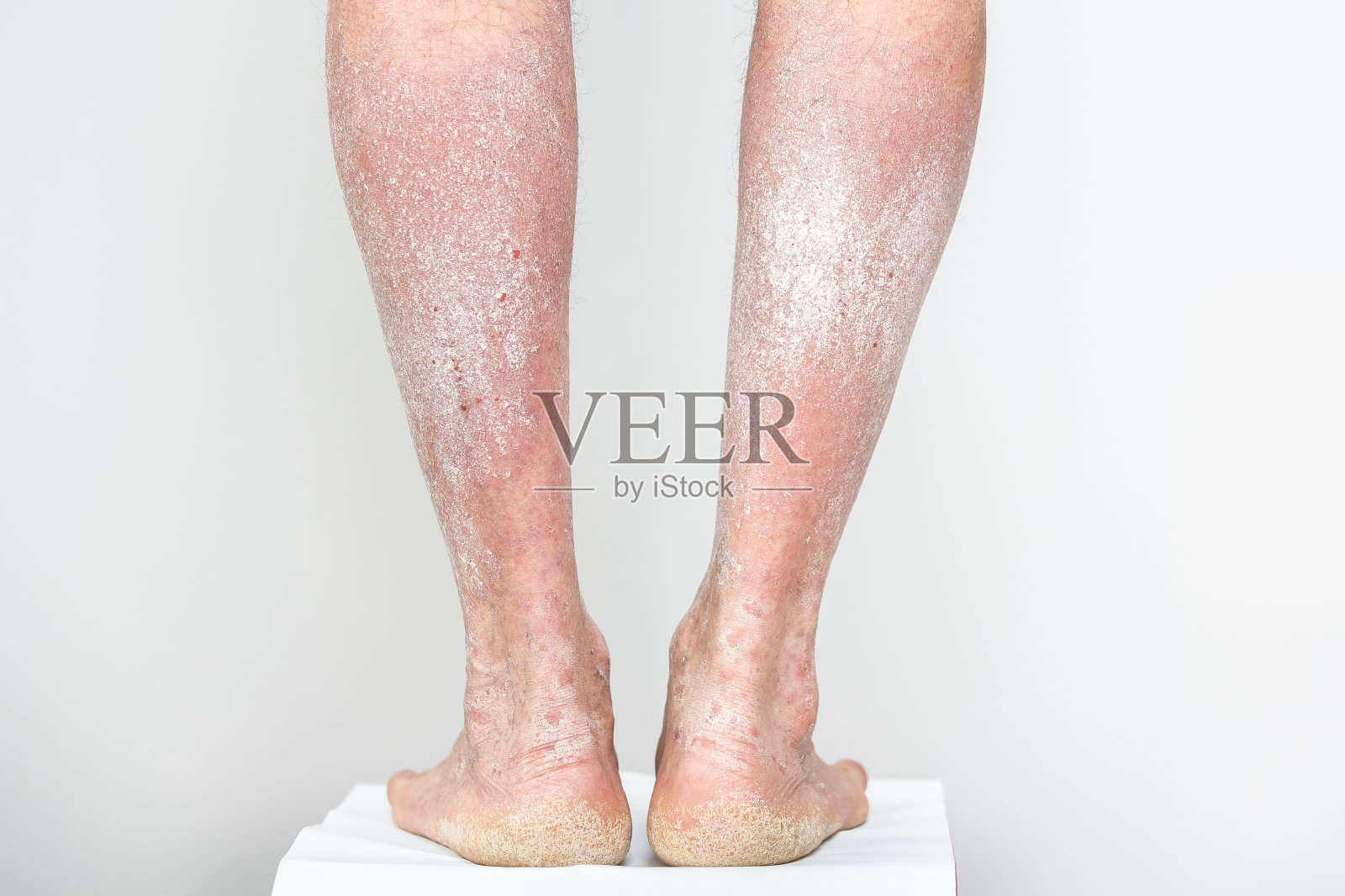 急性牛皮癣对男性腿和脚跟是一种自身免疫不可治愈的皮肤病。腿上有大片红肿片状皮疹照片摄影图片
