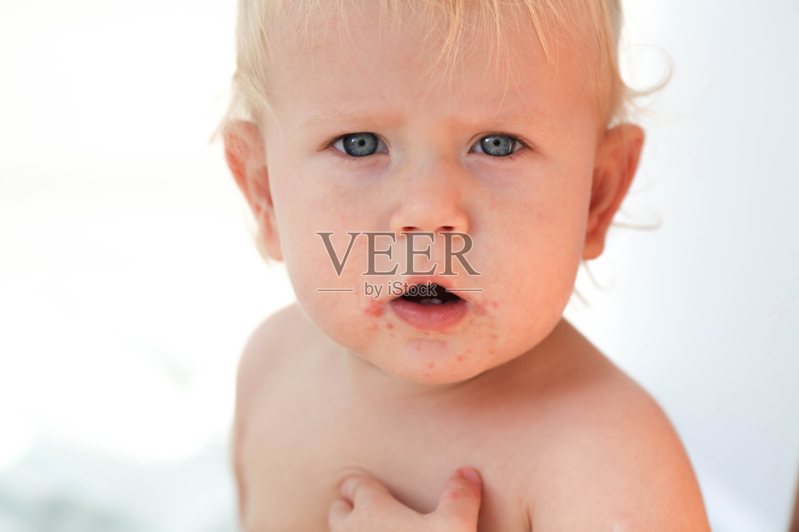 一个婴儿的肖像与皮疹附近的嘴。肠道病毒，儿童过敏。照片摄影图片