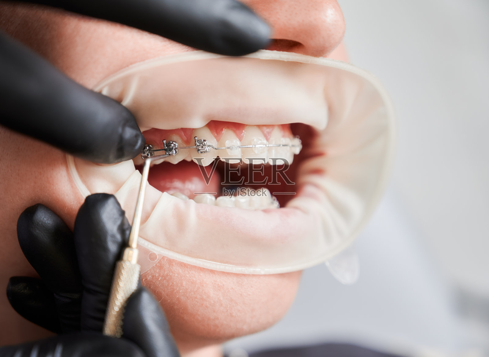 正牙医师在女性病人牙齿上放置牙套。照片摄影图片