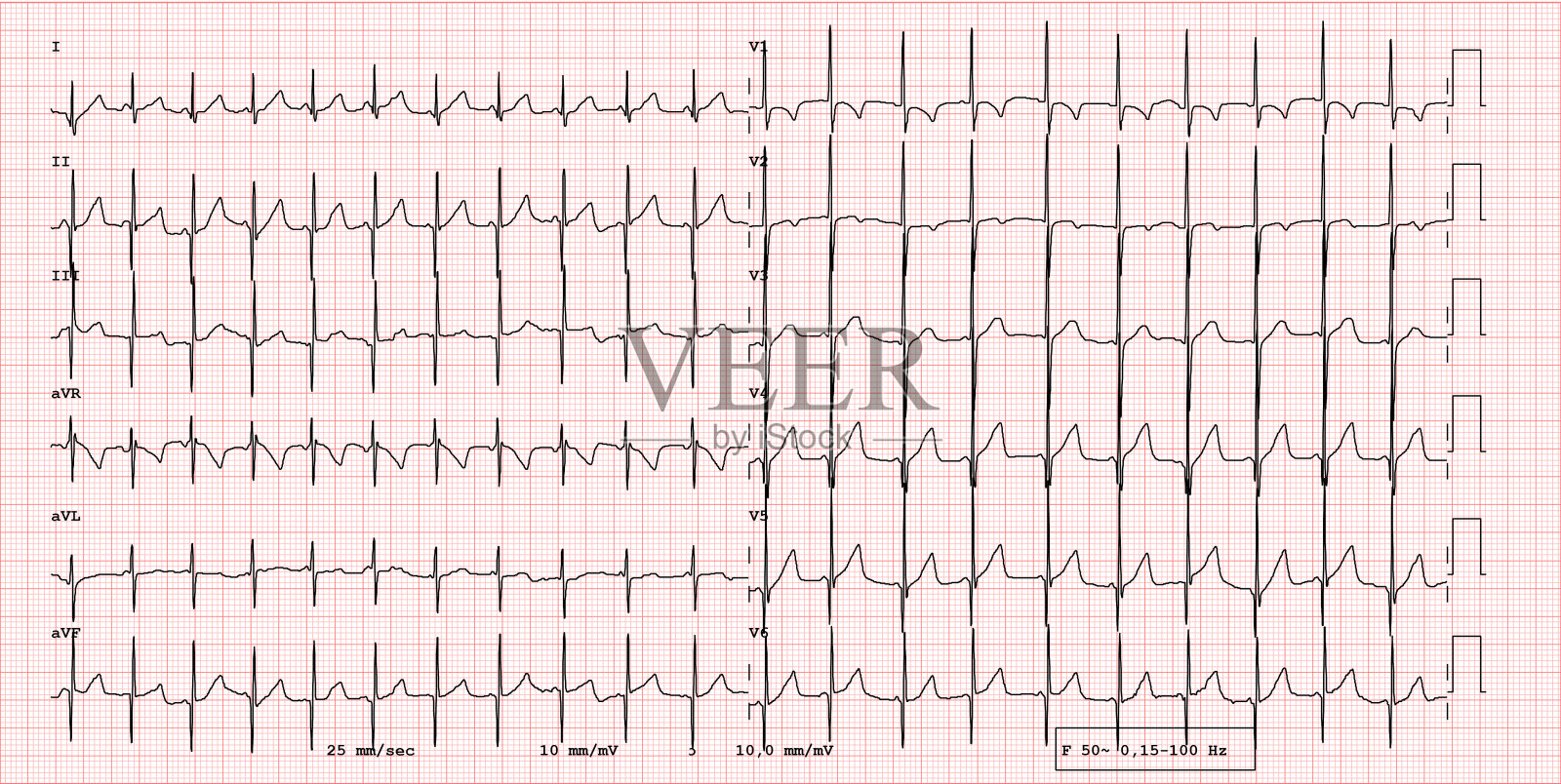 先天性心脏病，心电图上能看出什么？_先天性心脏病_心电图_医脉通