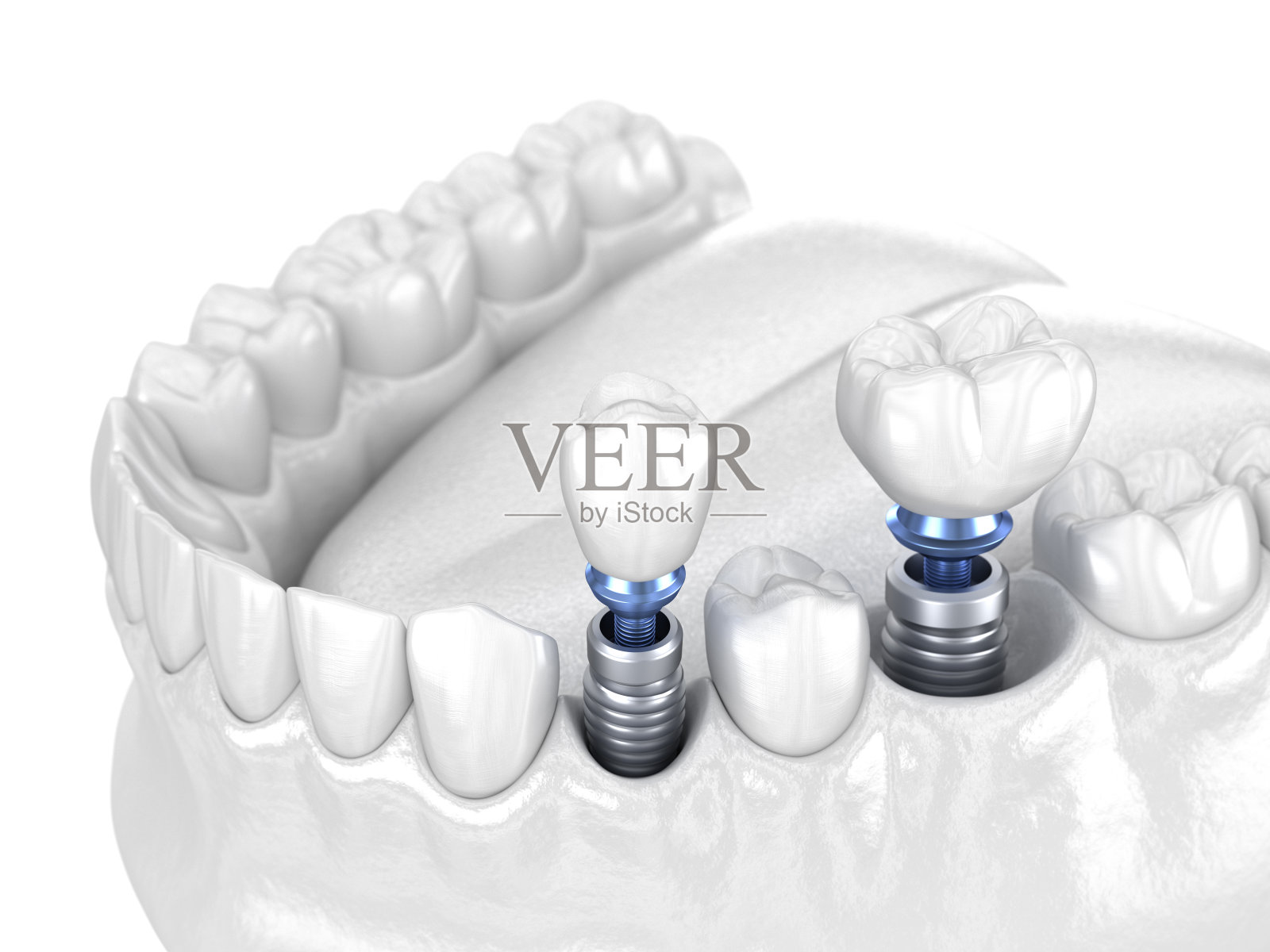 前磨牙和磨牙冠安装在种植体上-白概念。人类牙齿和假牙的3D插图照片摄影图片
