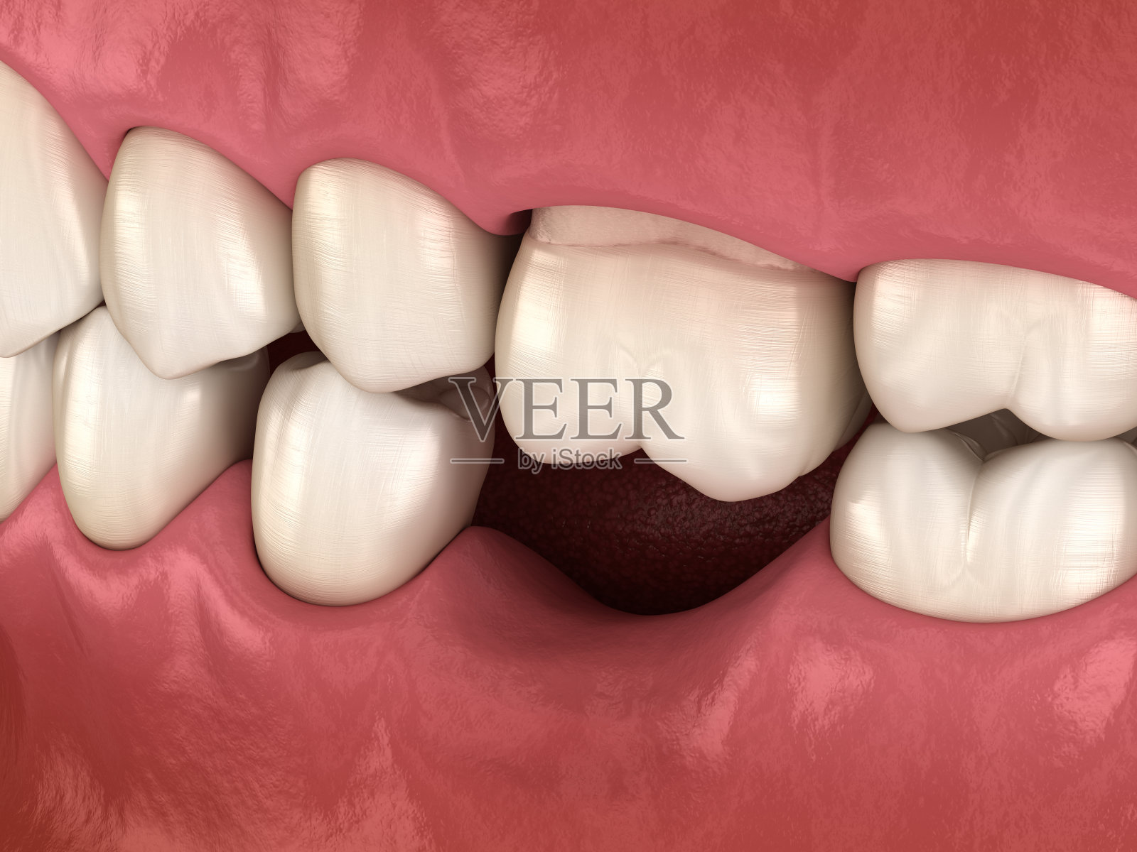 失臼齿后牙齿移位变形。Popov Godon现象的3D插图照片摄影图片